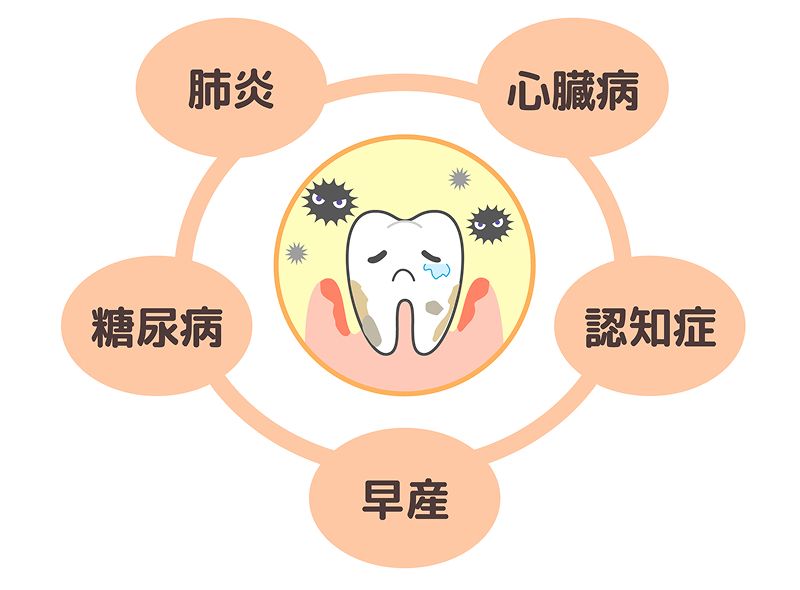 歯周病が引き起こす心臓病・糖尿病・肺炎・早産・認知症などの全身疾患